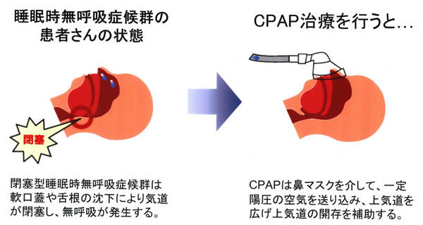 CPAP治療